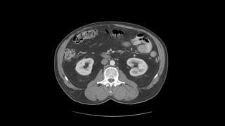 Abdominal CT scan | PPTX