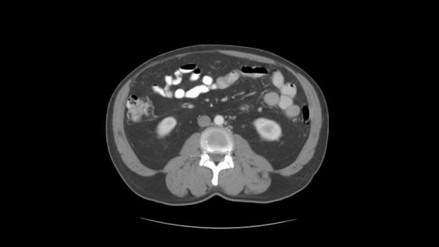 Abdominal CT scan | PPTX | Digestive Disorders | Diseases and Conditions
