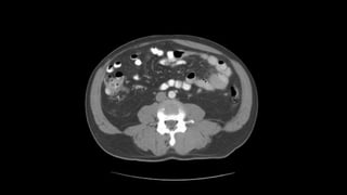 Abdominal CT scan | PPTX