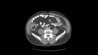 Abdominal CT scan | PPTX