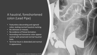 Haustral Activity Abdominal disease | PDF
