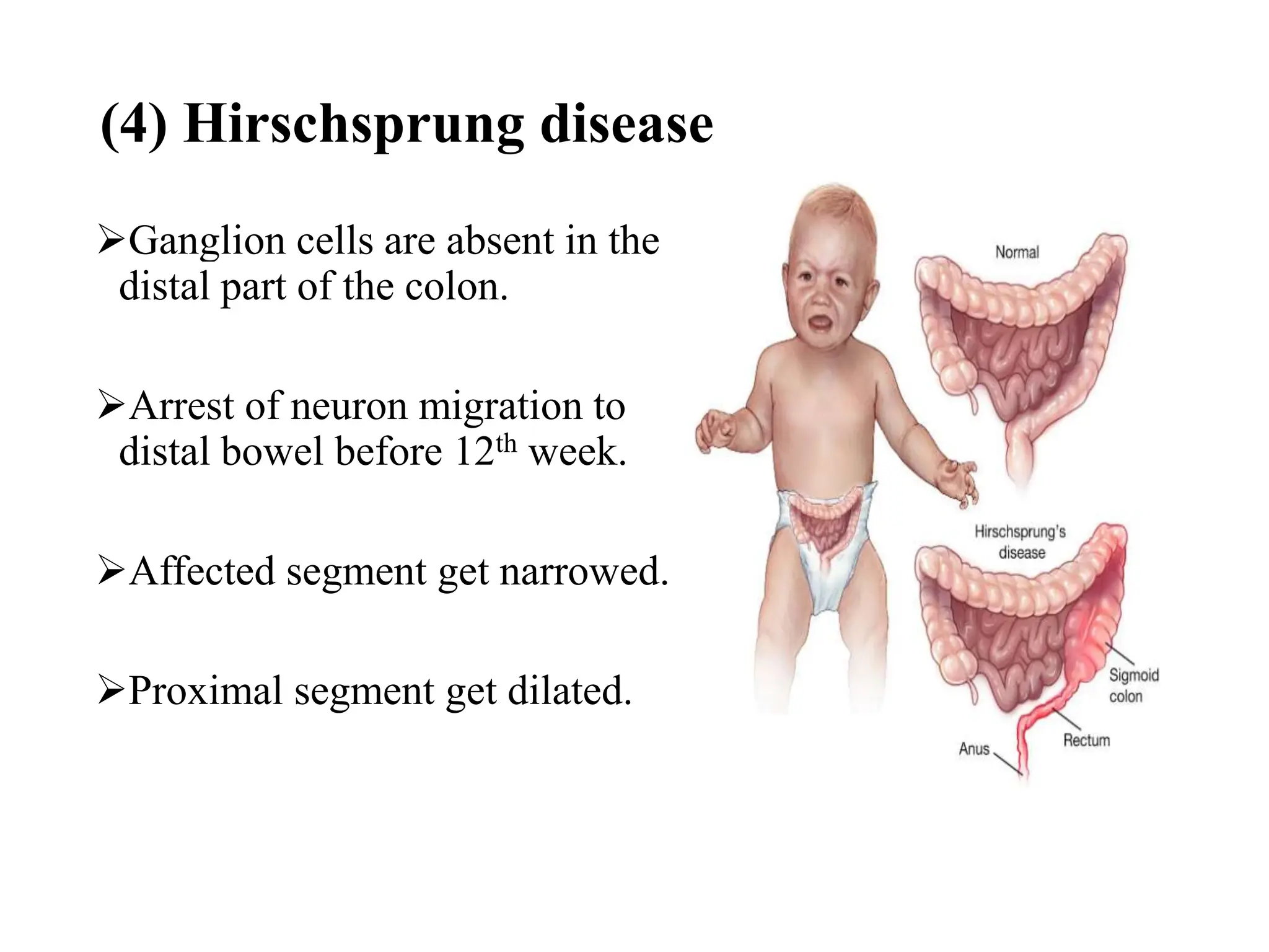 abdominal-distension-in-neonates-part-2-pptx