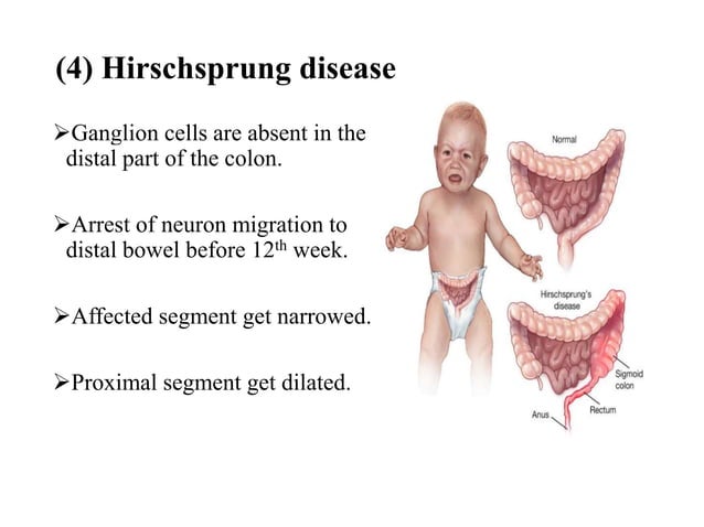 Abdominal Distension in Neonates Part 2.pptx | Digestive Disorders ...