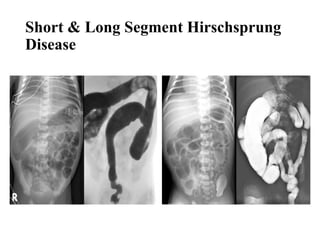 Long Segment Abdominal Distension in Neonates Part 2.pptx