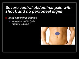 Severe central abdominal pain with
shock and no peritoneal signs
 Intra-abdominal causes
 Acute pancreatitis (pain
radiating to back)
 