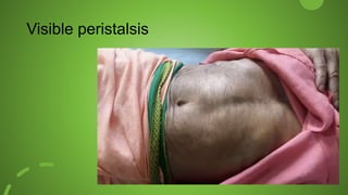 Visible peristalsis