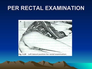 PER RECTAL EXAMINATION 