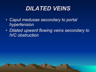 DILATED VEINS Caput medusae secondary to portal hypertension Dilated upward flowing veins secondary to IVC obstruction 