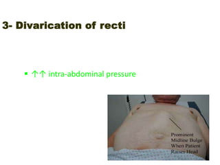 3- Divarication of recti
Bulge of linea alba between the recti muscles with their
wide separation
Causes:
 ↑↑ intra-abdominal pressure (ascites, multiple
pregnancies)
 