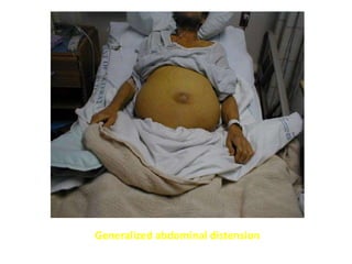 Generalized abdominal distension
 