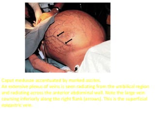 Caput medusae accentuated by marked ascites.
An extensive plexus of veins is seen radiating from the umbilical region
and radiating across the anterior abdominal wall. Note the large vein
coursing inferiorly along the right flank (arrows). This is the superficial
epigastric vein.
 