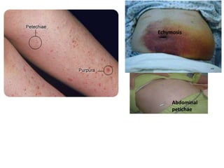 It is often difficult to understand whether tiny red spots arising on skin
surface are Petechiae or Purpura. However, Petechiae spots have a very
small diameter that is maximum 3 mm in size. Purpura rashes are larger
in size. These have a diameter that is about 5 mm. A spot that is bigger
than Purpura is known as common bruise or echymosis
Echymosis
Abdominal
petichae
 