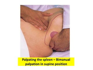 Palpating the spleen – Bimanual
palpation in supine position
 