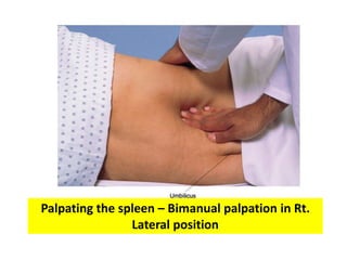 Palpating the spleen – Bimanual palpation in Rt.
Lateral position
 