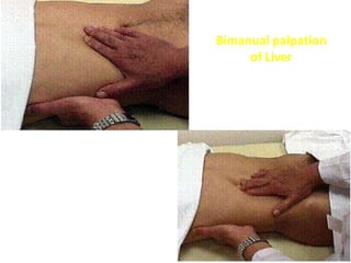 the left hand is held posteriorly,
between the 12th rib and the iliac crest.
It is lifted gently upward to elevate the
bulk of the liver into a more easily
accessible position, while the right
hand is held anterior and lateral to the
rectus musculature. The right hand
moves upward using gentle, steady
pressure until the liver edge is felt.
Bimanual palpation
of Liver
 