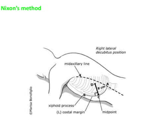Nixon’s method
 Place the patient in Right lateral decubitus
 Begin percussion midway along the Left costal margin
 Proceed in a line perpendicular to the Left costal margin
 Upper limit of dullness : 8 cm
 