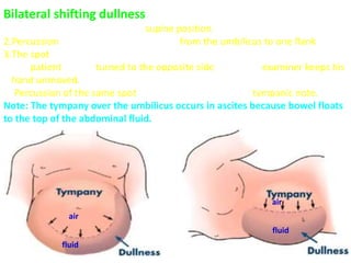 Bilateral shifting dullness
1.The patient is examined in the supine position.
2.Percussion is done over the abdomen, from the umbilicus to one flank.
3.The spot of the transition from tympany to dullness is detected.
4.The patient is then turned to the opposite side, while the examiner keeps his
hand unmoved.
5. Percussion of the same spot (which is top now) gives a tympanic note.
Note: The tympany over the umbilicus occurs in ascites because bowel floats
to the top of the abdominal fluid.
air
air
fluid
fluid
 