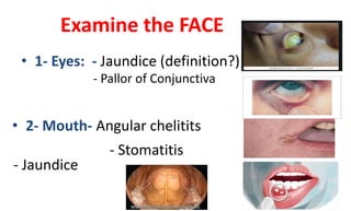 Examine the FACE
• 1- Eyes: - Jaundice (definition?)
- Pallor of Conjunctiva
• 2- Mouth- Angular chelitits
- Jaundice
- Stomatitis
 