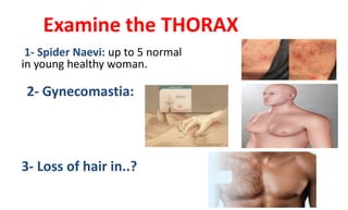 Examine the THORAX
1- Spider Naevi: up to 5 normal
in young healthy woman.
2- Gynecomastia:
3- Loss of hair in..?
 