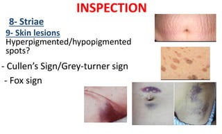 INSPECTION
8- Striae
9- Skin lesions
Hyperpigmented/hypopigmented
spots?
- Cullen’s Sign/Grey-turner sign
- Fox sign
 