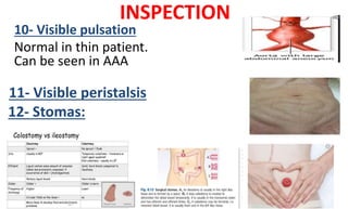 INSPECTION
10- Visible pulsation
Normal in thin patient.
Can be seen in AAA
11- Visible peristalsis
12- Stomas:
 