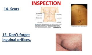 INSPECTION
14- Scars
15- Don’t forget
inguinal orifices.
 