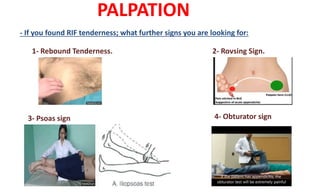 PALPATION
- If you found RIF tenderness; what further signs you are looking for:
1- Rebound Tenderness. 2- Rovsing Sign.
3- Psoas sign 4- Obturator sign
 