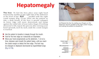 Hepatomegaly
 
