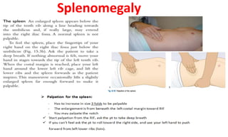Splenomegaly
 