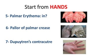 Start from HANDS
5- Palmar Erythema: in?
6- Pallor of palmar crease
7- Dupuytren’s contracutre
 