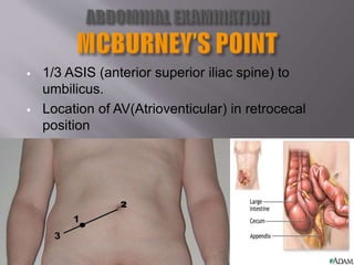  1/3 ASIS (anterior superior iliac spine) to
umbilicus.
 Location of AV(Atrioventicular) in retrocecal
position
 Deep tenderness (= acute appendicitis)
 