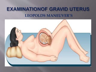 LEOPOLDS MANEUVER’S
 