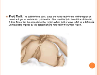  Fluid Thrill: The pt laid on his back, place one hand flat over the lumbar region of
one side & get an assistant to put the side of his hand firmly in the midline of the abd,
& then flick or tap the opposite lumbar region. A fluid thrill or wave is felt as a definite &
unmistakable impulse by the detecting hand held flat in the lumbar region.
 