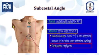 Subcostal Angle
 