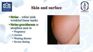 Skin and surface
• Striae – white/ pink
wrinkled linear marks
• Striae gravidarum or
atrophica seen in
• Pregnancy
• Ascites
• Wasting disease
• Severe dieting
 