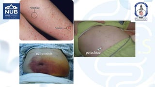 petechiae
echymosis
 