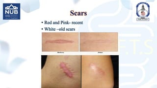 Scars
• Red and Pink- recent
• White –old scars
 