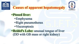 Causes of apparent hepatomegaly
•Ptosed liver:
•Emphysema
•Right pneumothorax
•Visceroptosis
•Reidel’s Lobe: unusual tongue of liver
(DD with GB mass or right kidney)
 
