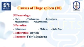 Causes of Huge spleen (10)
5 Hematology:
- CML - Thalassemia - Lymphoma -
Myelofibrosis - Polycythemia.
3 Parasites:
- Bilharziasis - Malaria - Kala Azar
1 Infiltrative: amyloid
1 Immune: Felty’s Syndrome
 