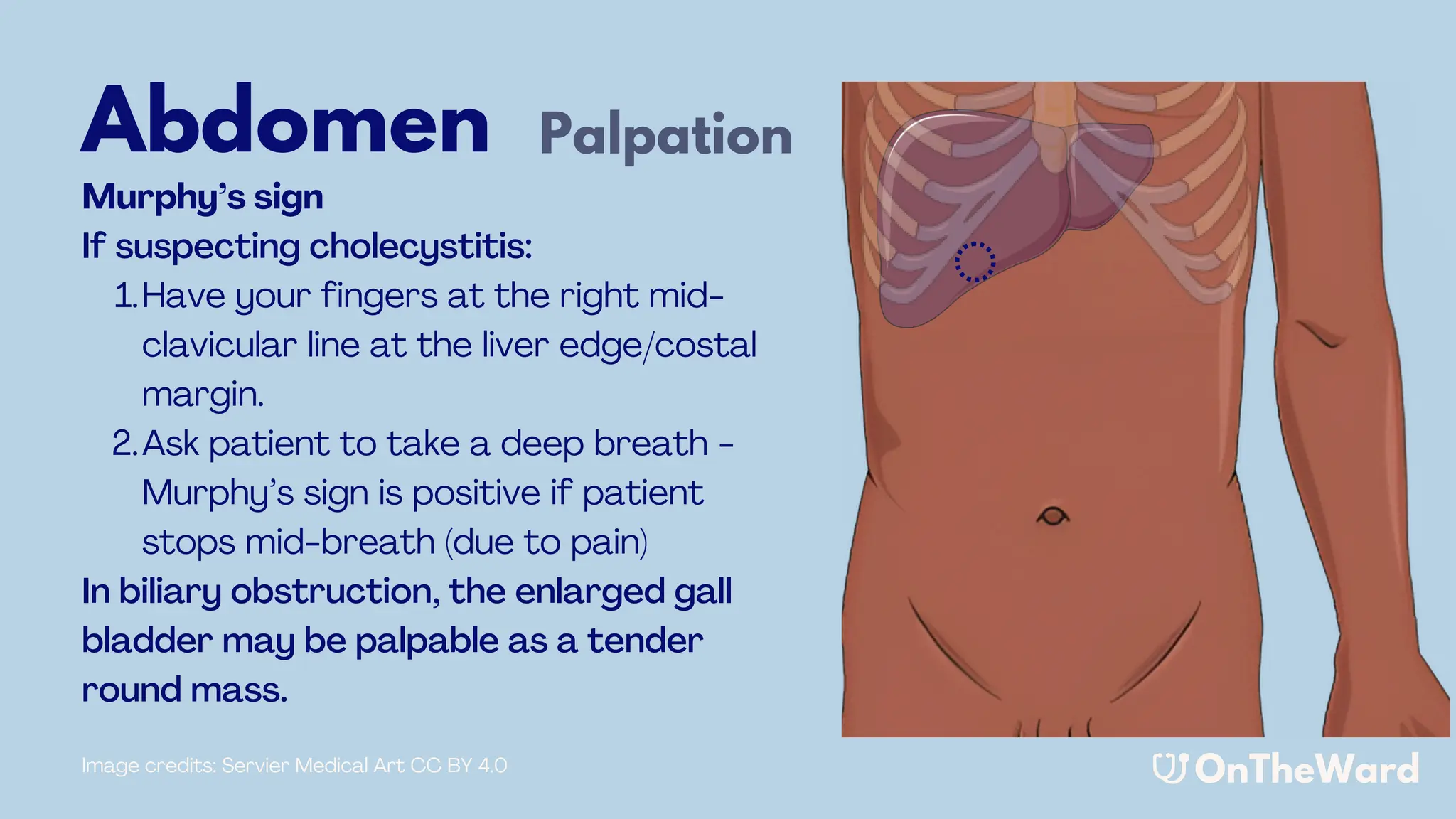 Murray Sign Abdominal Examination PowerPoint (OnTheWard.com)) | PDF