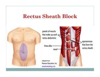 Rectus Sheath Block Target Abdominal field block.pdf