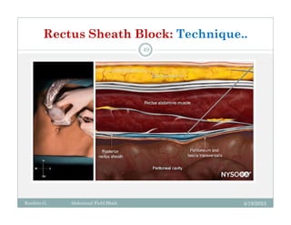Rectus Sheath Block Target Abdominal field block.pdf
