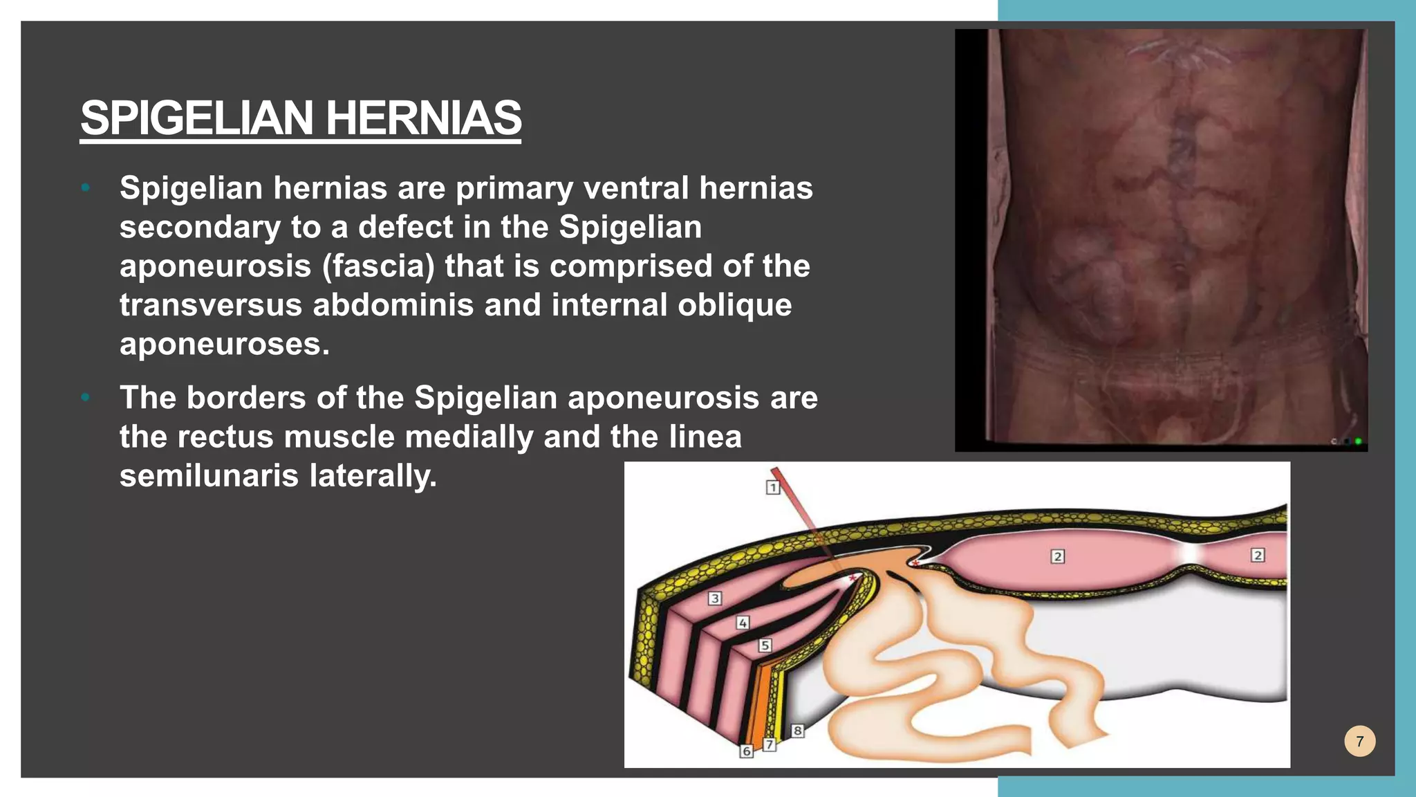 ABDOMINAL HERNIAS pptx