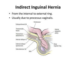 Indirect Inguinal Hernia
• From the internal to external ring.
• Usually due to processus vaginalis.
 