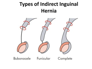 Types of Indirect Inguinal
          Hernia
 