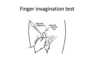 Finger invagination test
 