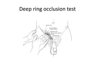 Deep ring occlusion test
 