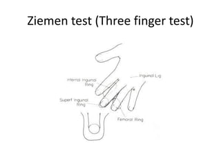 Ziemen test (Three finger test)
 