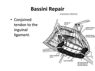 Bassini Repair
• Conjoined
  tendon to the
  inguinal
  ligament.
 