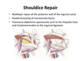 Shouldice Repair
• Multilayer repair of the posterior wall of the inguinal canal
• Double breasting of transversalis fascia
• Transverse abdominis aponeurotic arch to the iliopubic tract
  and Conjoined tendon to the inguinal ligament
 